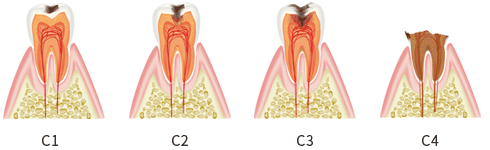 虫歯の症状4段階