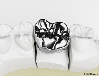 被せ物（銀歯）